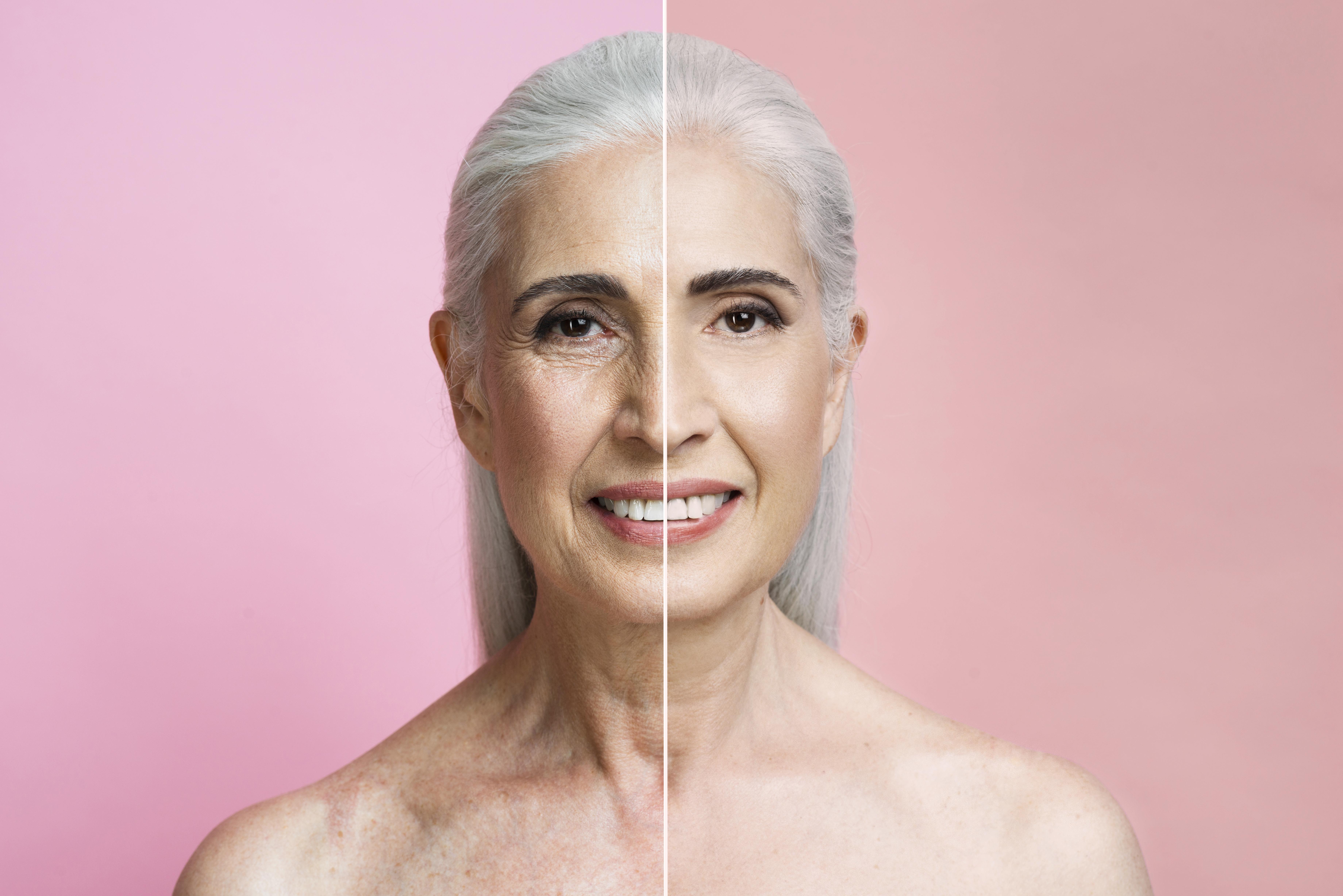 Facelift Surgery: A Comparative Guide between Turkey and the United Kingdom β¨πββοΈπ