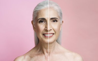 facelift
