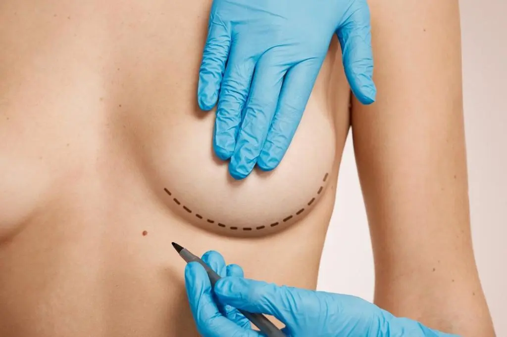 Breast Augmentation: Turkey vs United Kingdom – A Comprehensive Guide ✨💉🌍