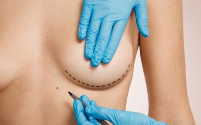 woman-marked-out-cosmetic-surgery