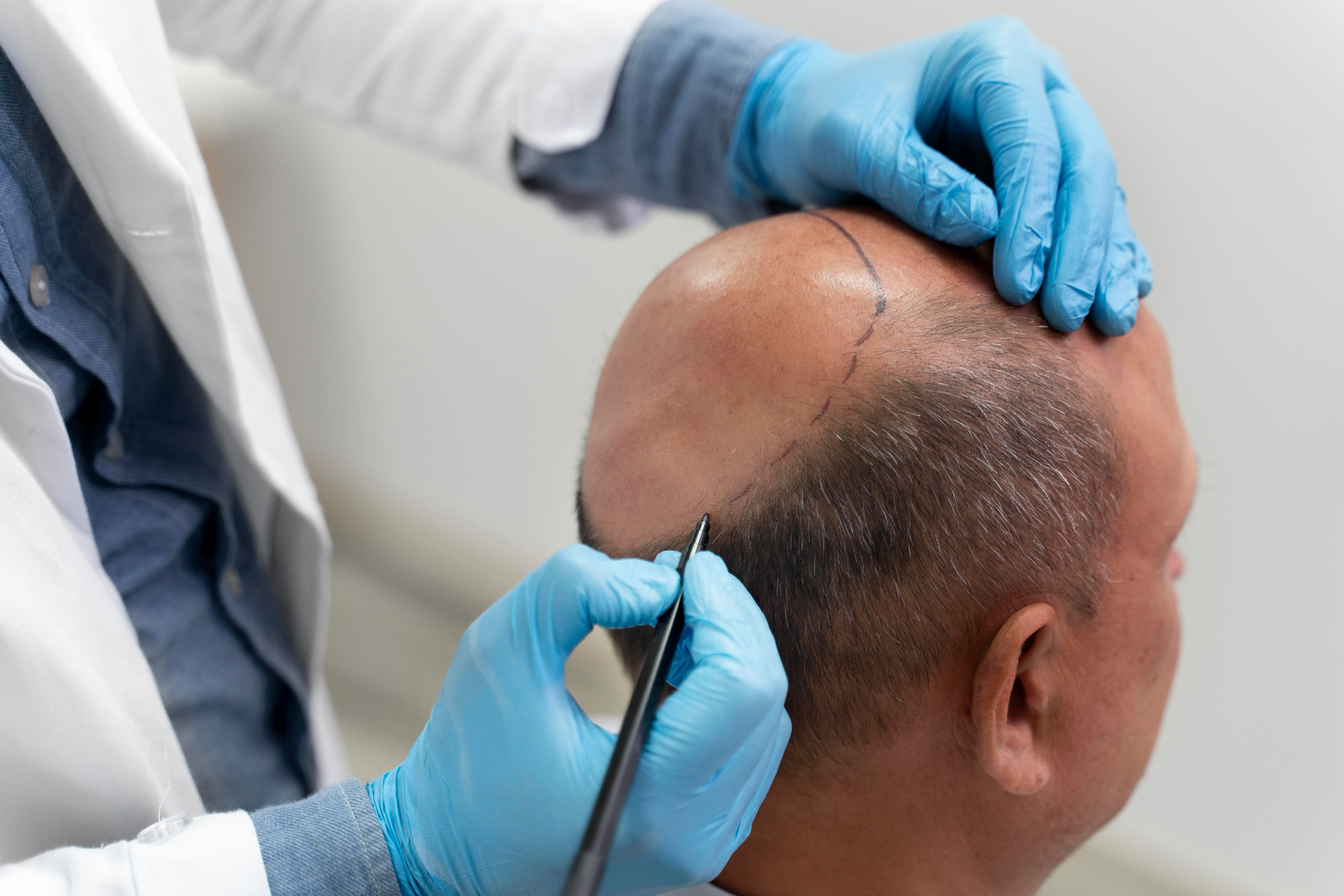 Best Places for Hair Transplant: Pros & Cons of Top Countries โ๏ธ๐โโ๏ธ๐