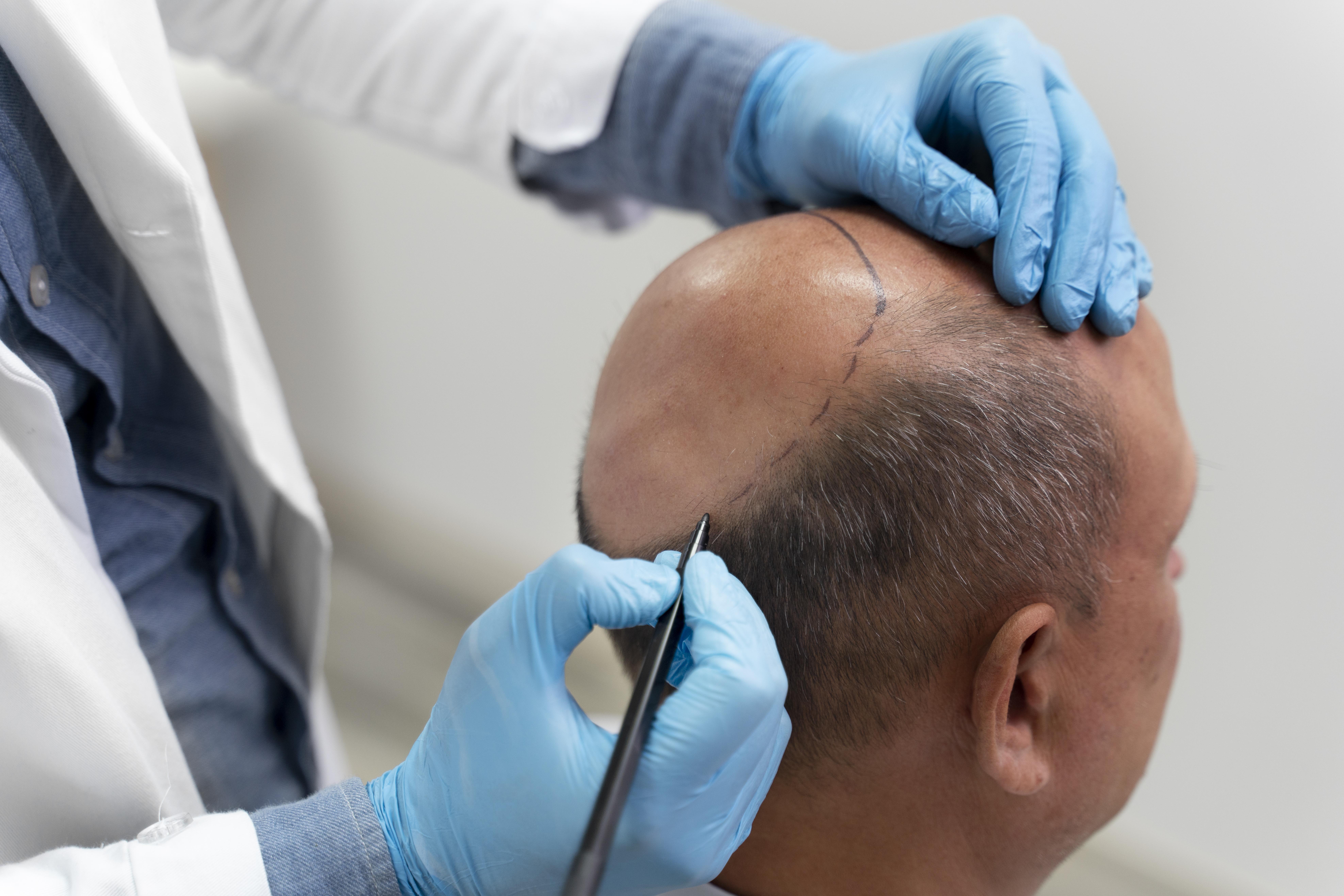 Best Places for Hair Transplant: Pros & Cons of Top Countries โ๏ธ๐โโ๏ธ๐