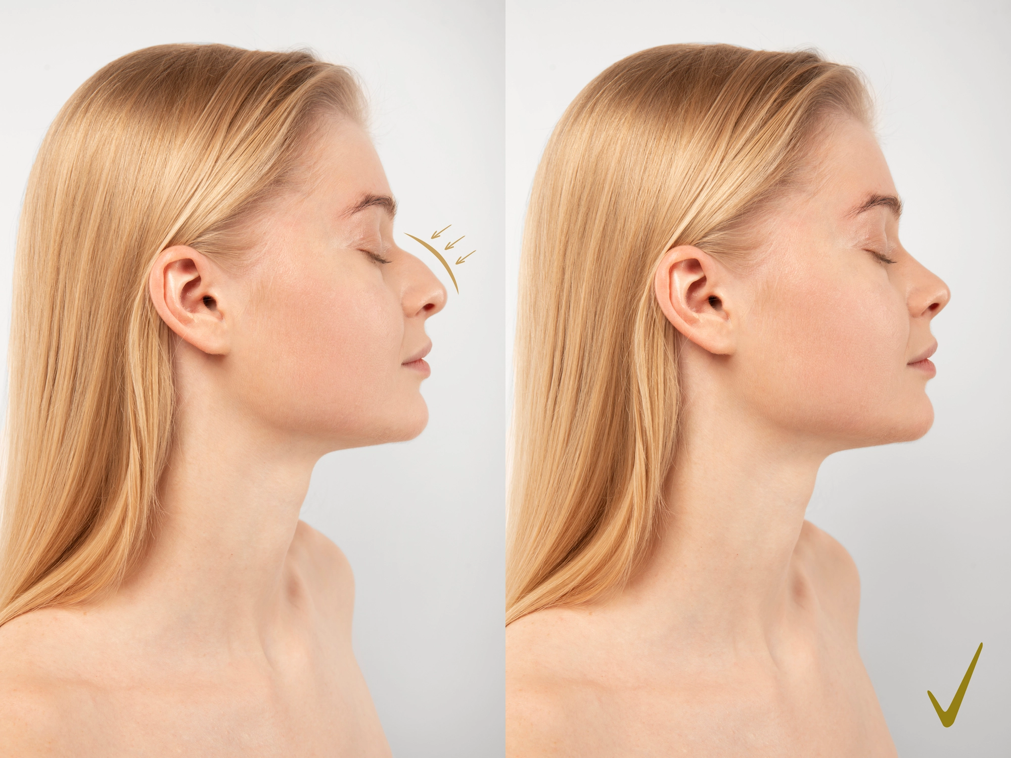 Top 10 Celebrities Who Had Rhinoplasty: Before and After Transformations โจ๐๐