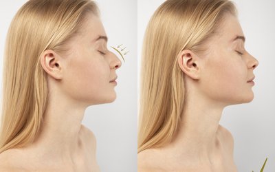 woman-getting-ready-nose-job-surgery