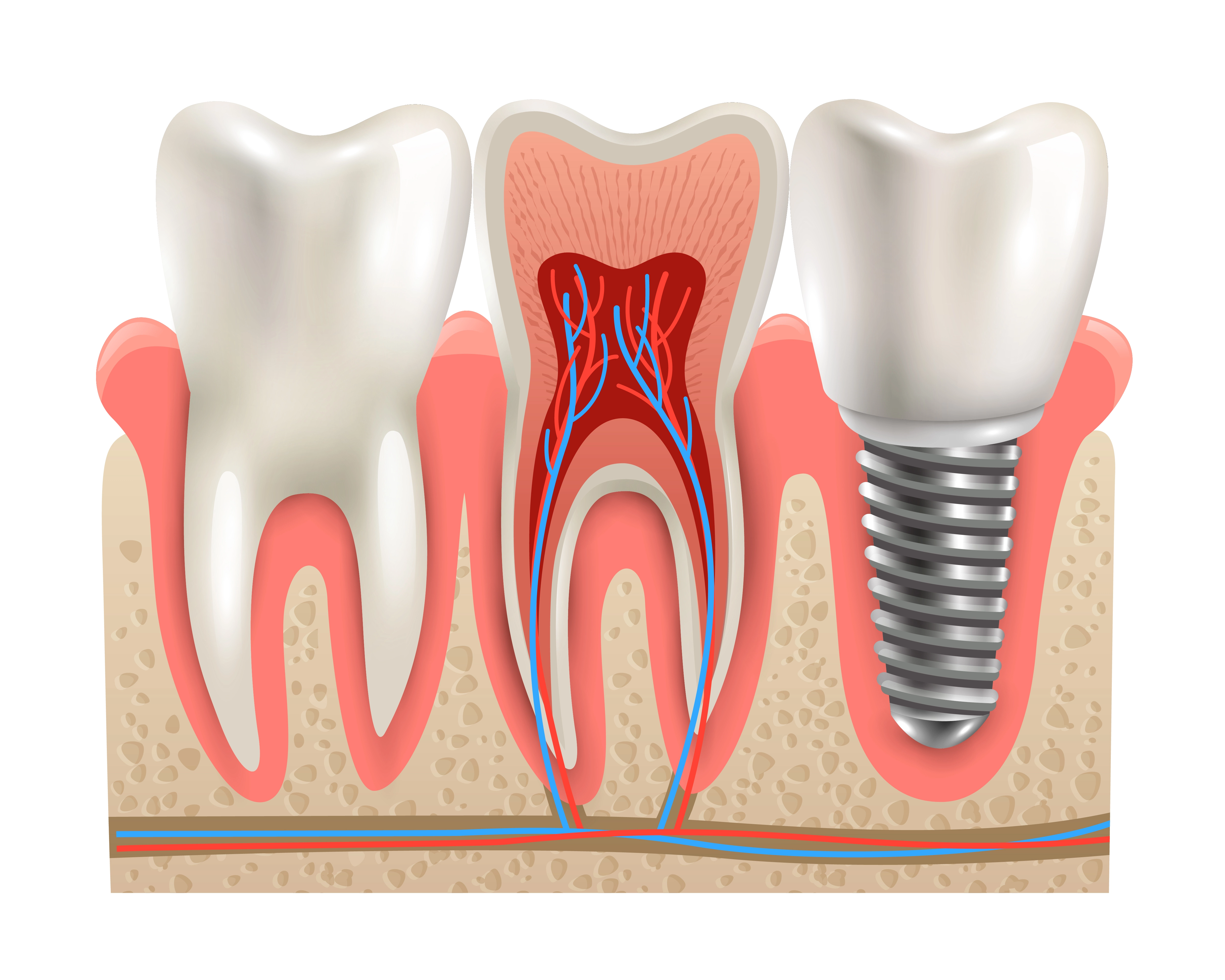Dental Implants: Why Turkey is the Best Choice for Affordable and High-Quality Treatment β¨π¦·π
