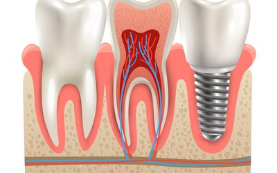 implants