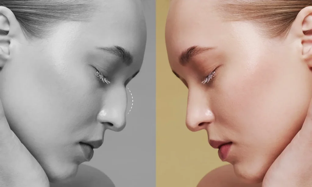 The Ultimate Guide to Nose Jobs in Turkey: A Blend of Quality, Expertise, and Affordability