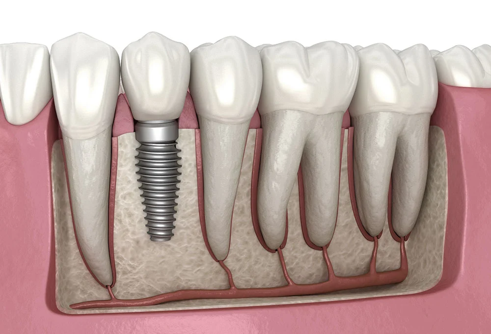 The 7 Best Countries for Dental Implants ✨🦷🌍