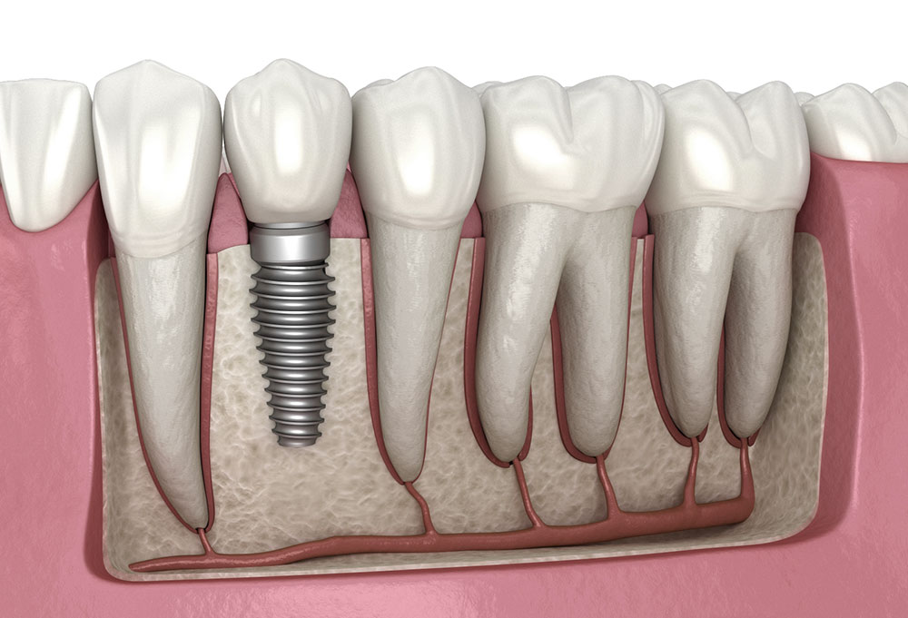 The 7 Best Countries for Dental Implants ✨🦷🌍