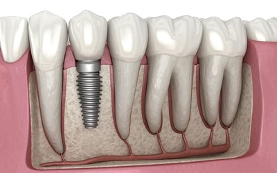 Dental-implant-illustration